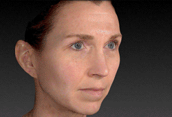 3D Facial Skin Analysis