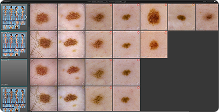 Dermoscopic images organized by DermaGraphix for efficient review