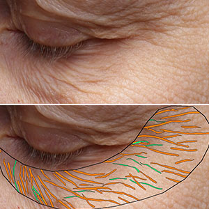 Wrinkles and Fine Line Detection
