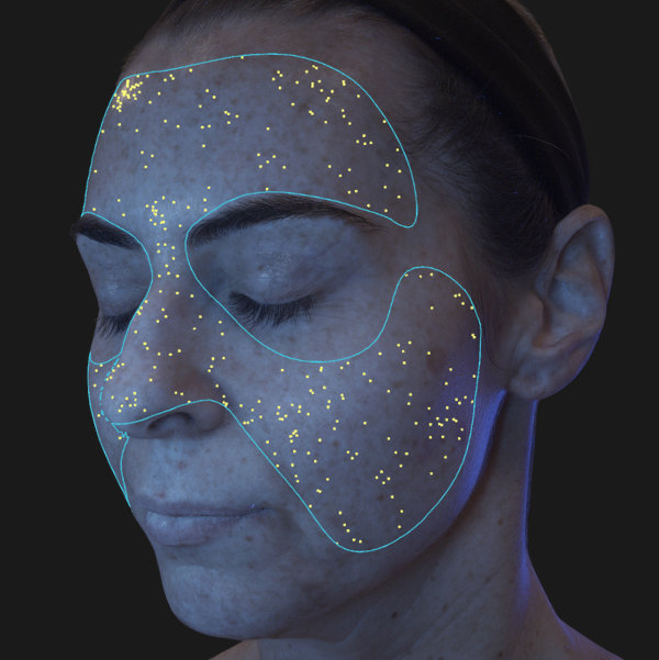 Advanced Skin Analysis - Porphyrins