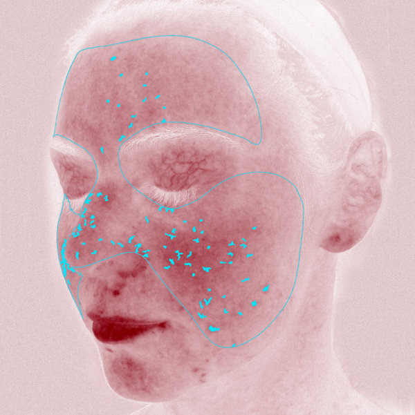 Advanced Skin Analysis - Red Areas