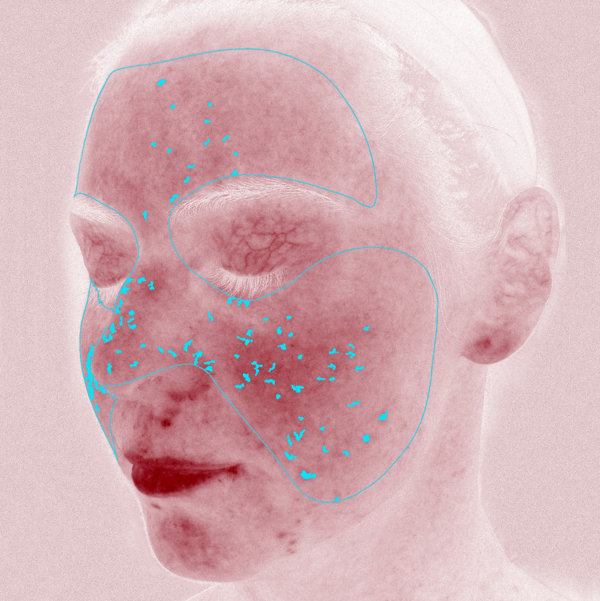 Advanced Skin Analysis - Red Areas