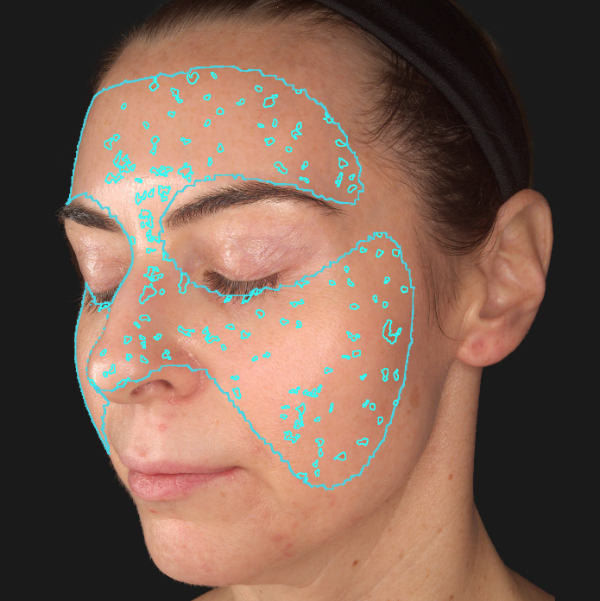 Advanced Skin Analysis - Spots