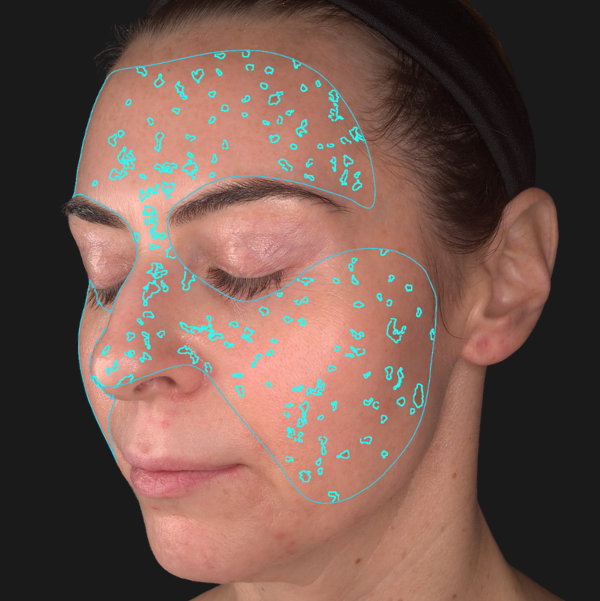 Advanced Skin Analysis - Spots