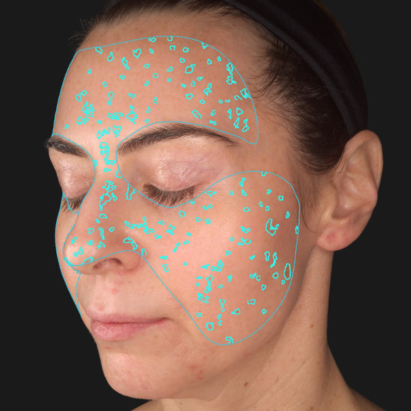 Advanced Skin Analysis - Spots