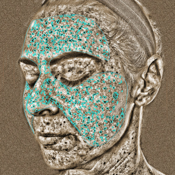 Advanced Skin Analysis - UV Spots