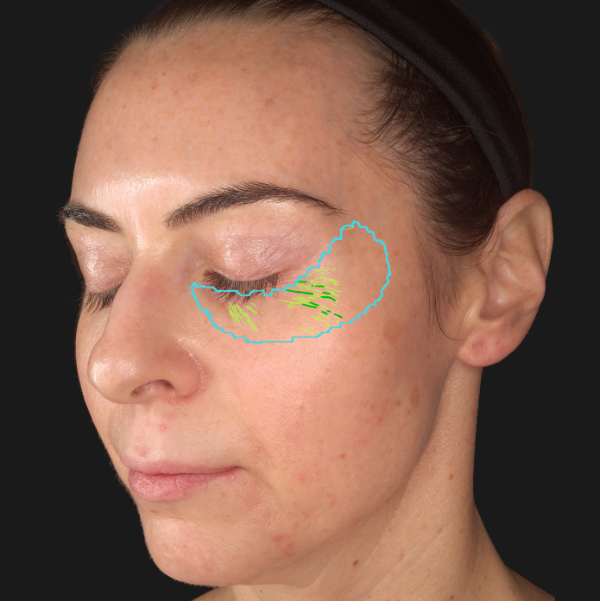 Advanced Skin Analysis - Wrinkles