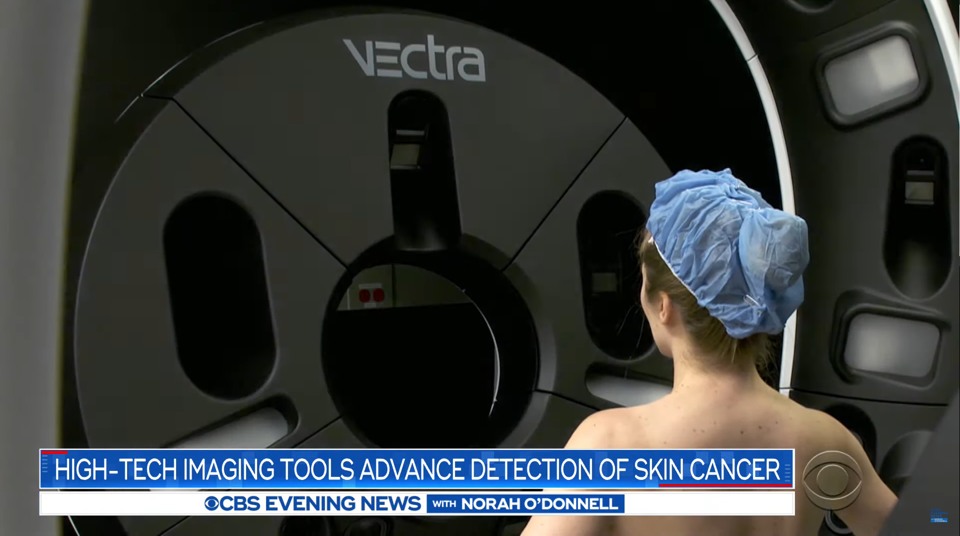 Dr. Allan Halpern of Memorial Sloan Kettering Cancer Center discusses VECTRA® WB360 technology on CBS News 