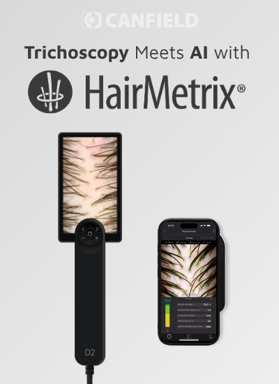 Trichoscopy Meets AI with HairMetrix®: A Smarter Approach to Hair Consultations